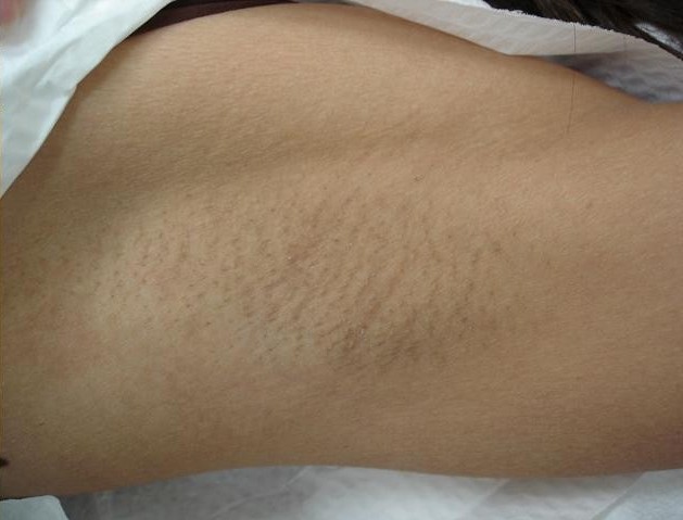 After Hair Removal Treatment
