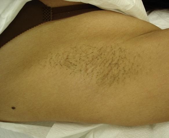Before Hair Removal Treatment